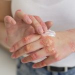 Psoriasis