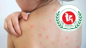 হাম ও উপসর্গে আরও ৫ শিশুর মৃত্যু