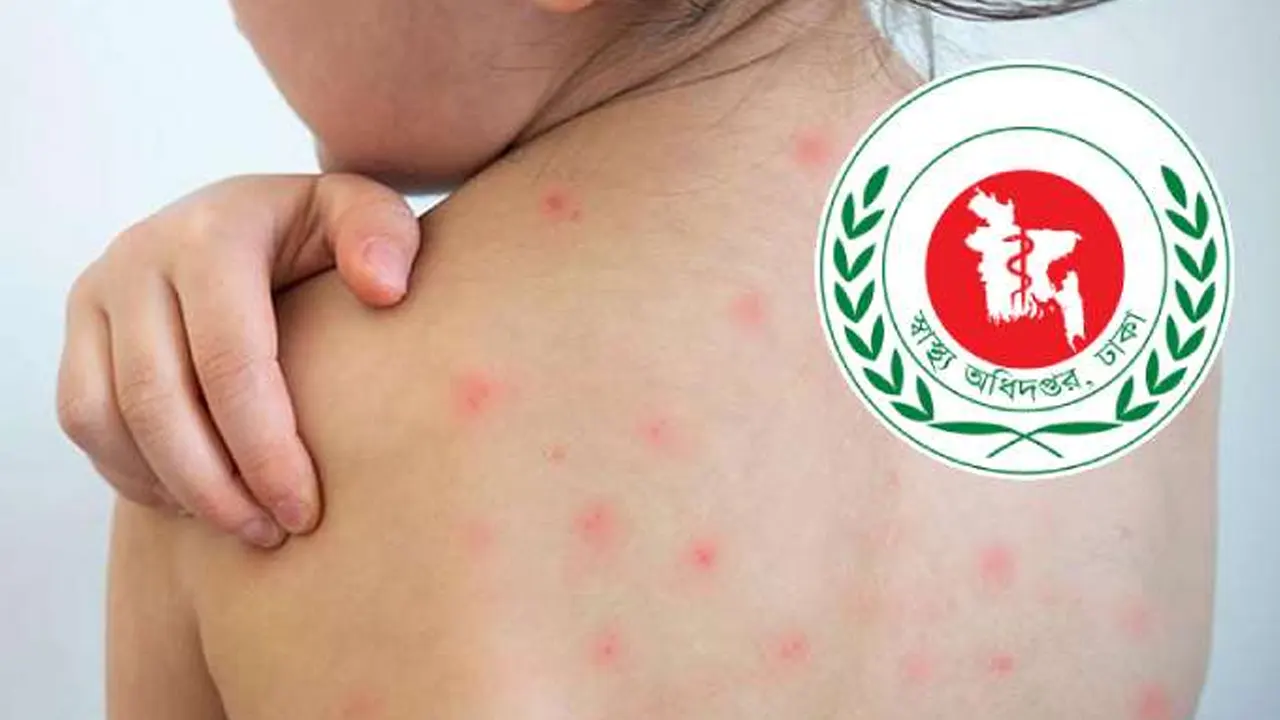 হাম ও উপসর্গে আরও ৫ শিশুর মৃত্যু