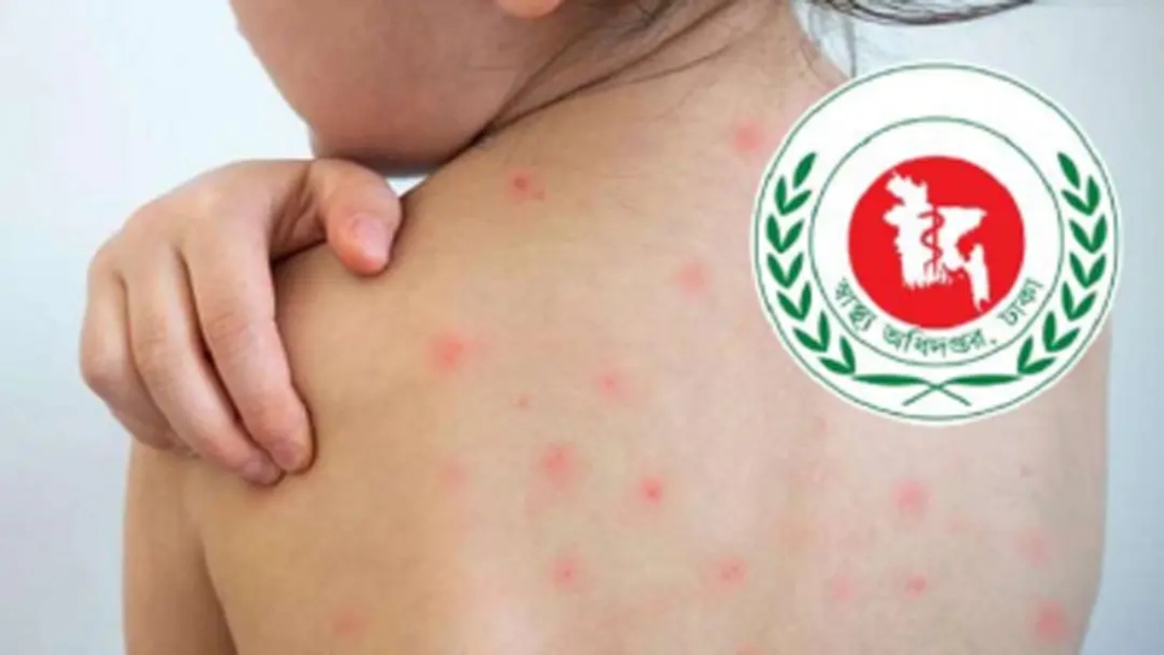 হাম উপসর্গে আরও ১১ শিশুর মৃত্যু