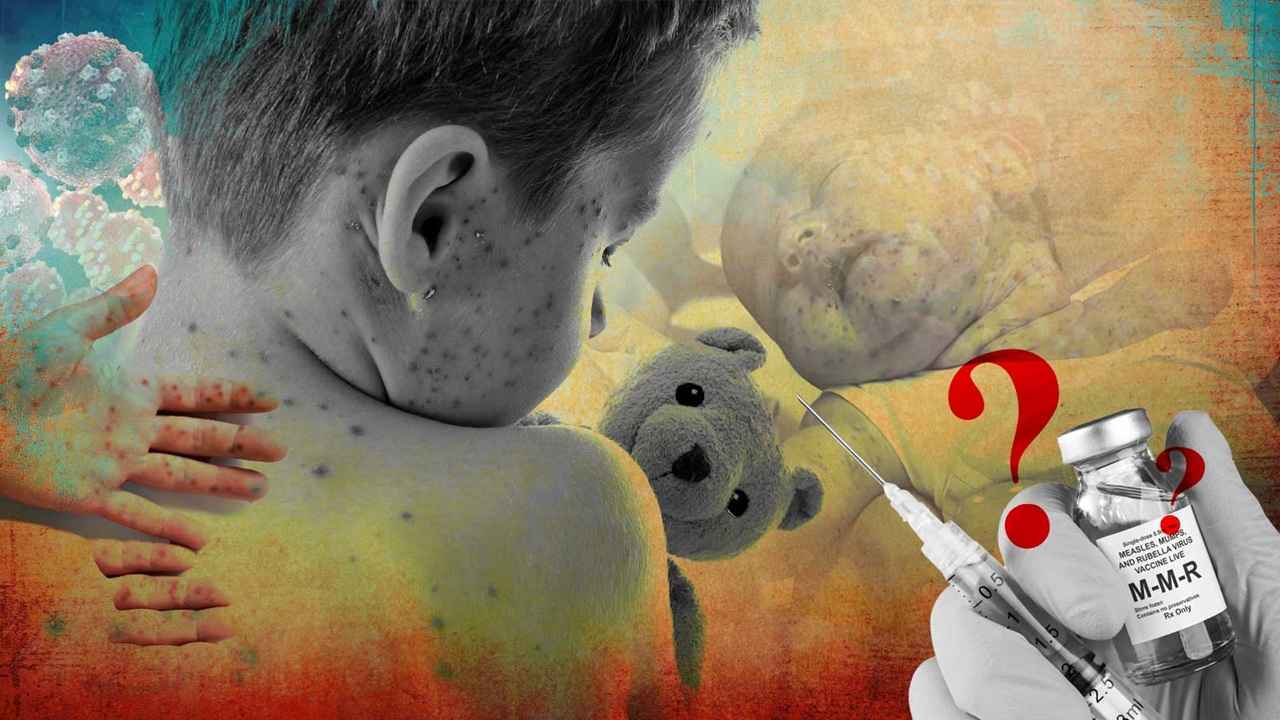 কমছেই না হামের ভয়াবহতা, ৪৫১ শিশুর মৃত্যুতে দেশজুড়ে উদ্বেগ