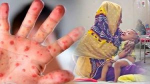 হাম ও উপসর্গে আরও ৭ শিশুর মৃত্যু