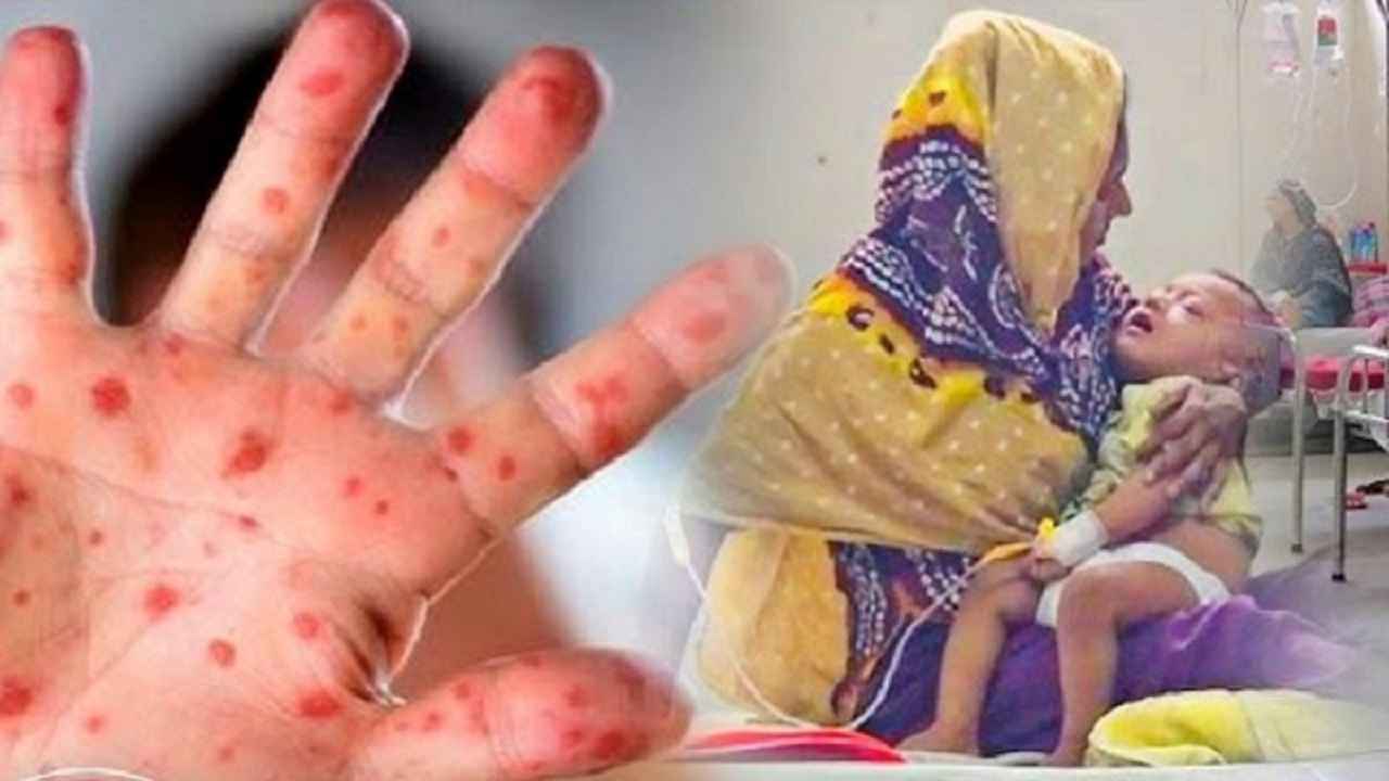 হাম উপসর্গে প্রাণ গেল আরও ৬ শিশুর