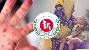 হাম ও উপসর্গে মৃত্যু ৫০০ ছাড়াল