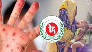 হাম উপসর্গে আরও ১৬ শিশুর মৃত্যু