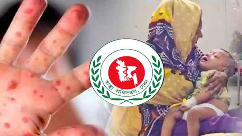 হাম উপসর্গে আরও ৯ শিশুর মৃত্যু